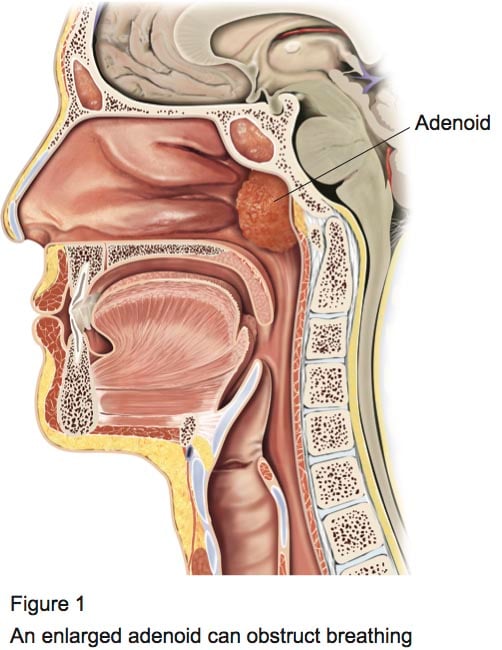 Figure 1 - Adeinodectomy