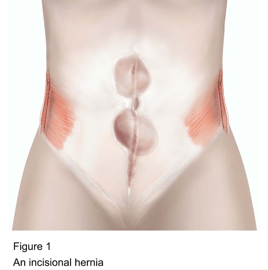 Figure 1 - An incisional hernia