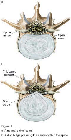 Figure 1- Lumbar laminectomy