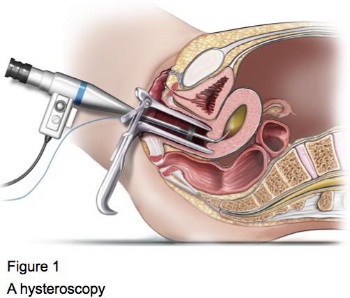 Figure 1 - Hysteroscopy