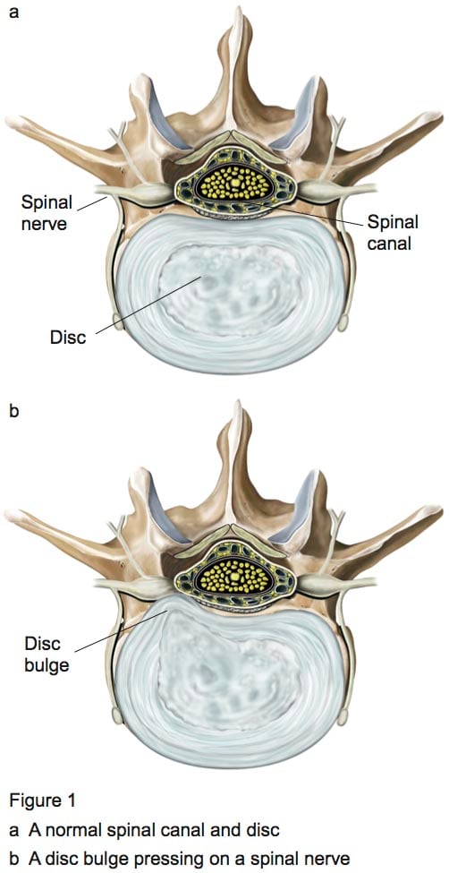 Figure 1 - Lumbar dissectomy