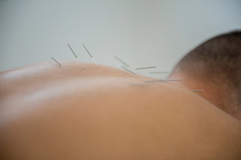 Physiotherapy Acupuncture