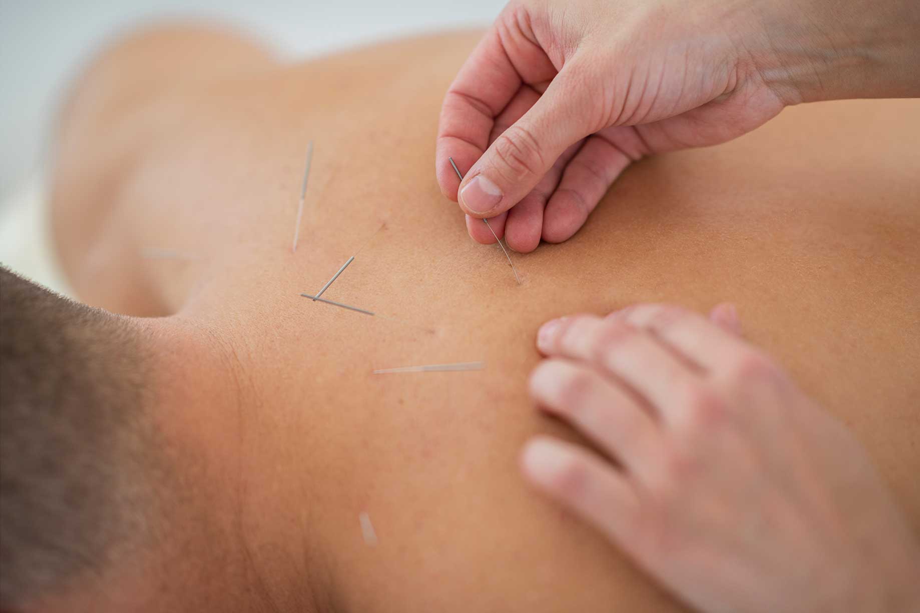Acupuncture on the back