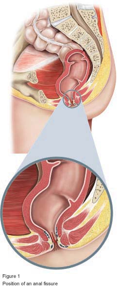 Lateral Internal Sphincterotomy