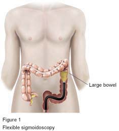 Flexible Sigmoidoscopy