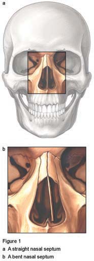 Deviated Nasal Septum figure 1