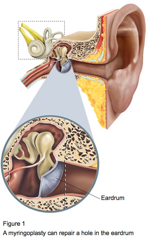 Figure 1 - Myringoplasty