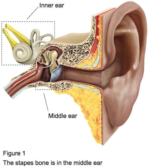 Grommet insertion