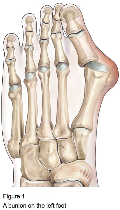 FIgure 1 - A bunion on the left foot