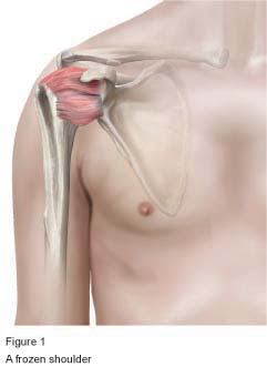 Figure 1 - A frozen shoulder