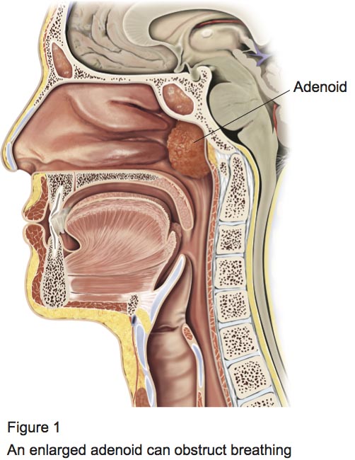 Figure 1 - Adeinodectomy