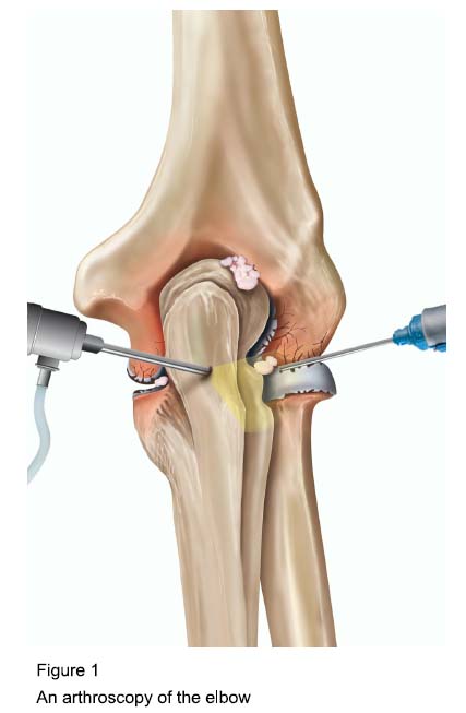 Figure 1 - An arthroscopy of the elbow