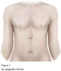 Figure 1 - An epigastric hernia