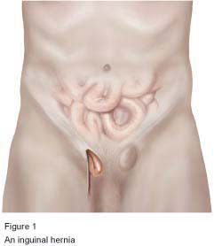 Figure 1 - An inguinal hernia (male)