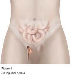 Figure 1 - An inguinal hernia