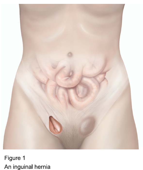 Figure 1 - An inguinal hernia