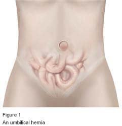 Figure 1 - An umbilical hernia