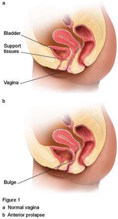 Figure 1 - Anterior prolapse