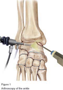 Figure 1 - Arthroscopy of the ankle