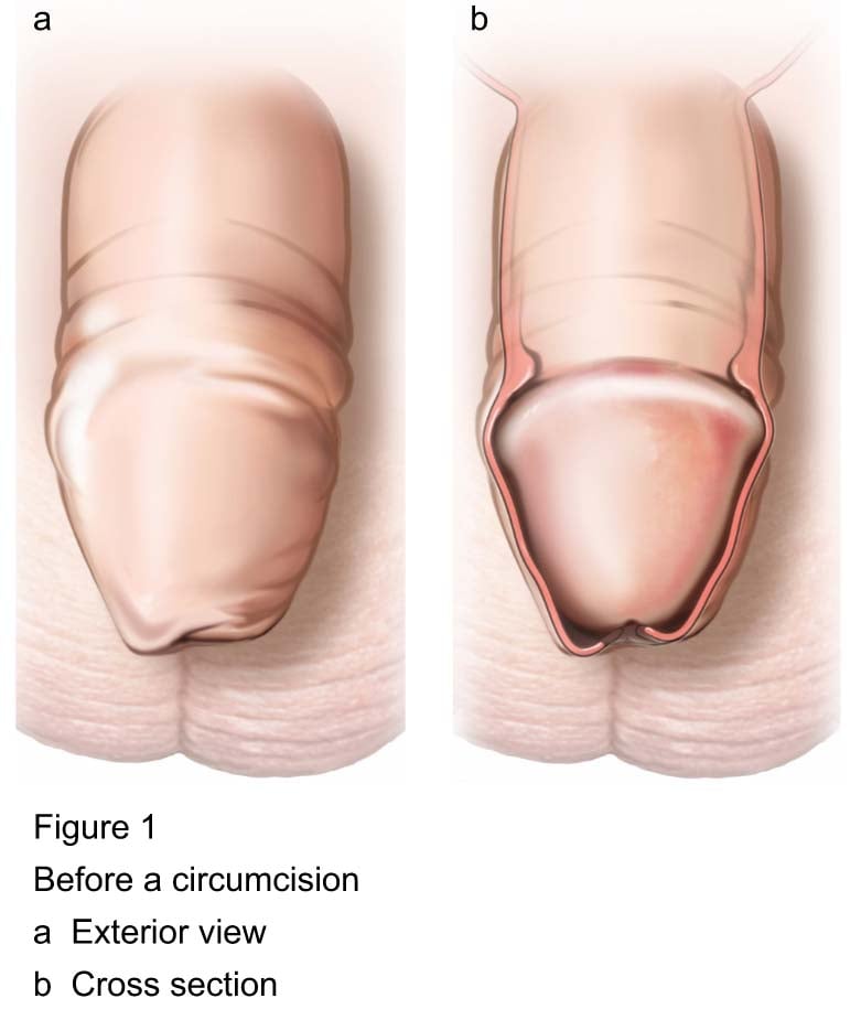 Figure 1 - Before a circumcision