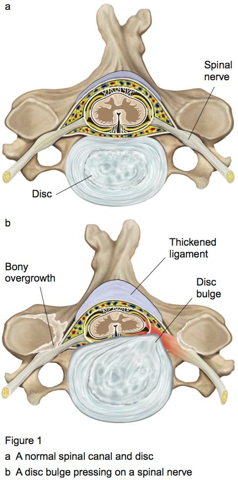 Figure 1 - Cervical laminectomy