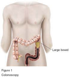 Figure 1 - Colonoscopy