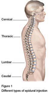 Figure 1 - Different types of epidural injection