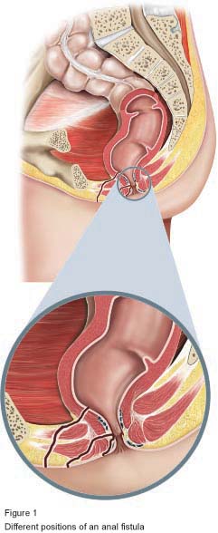 Figure 1 - Different positions of an anal fistula