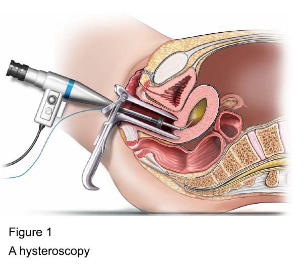 Figure 1 - Endometrial resection