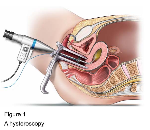 Endometrial Resection  New Victoria Hospital