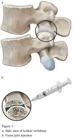 Figure 1 - Facet joint injection