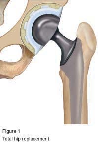 Figure 1 - total hip replacement