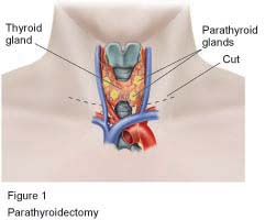 Figure 1 - Parathoidectomy