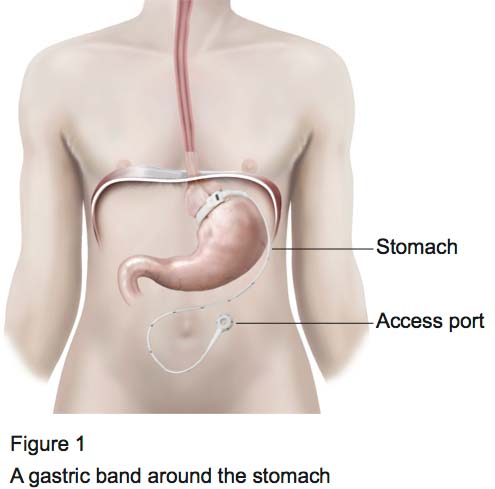 Figure 1 - Laparoscopic Gastric Banding