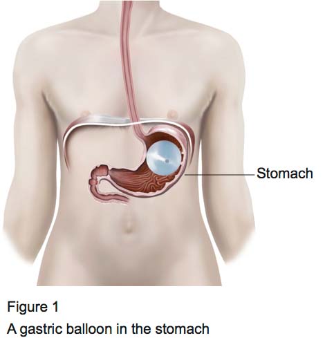 Gastric Balloon