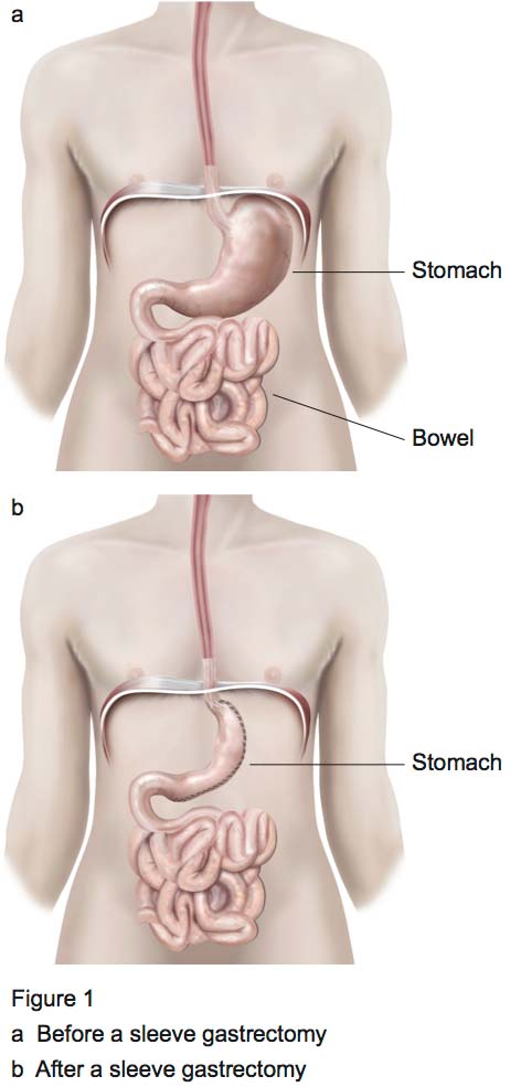Figure 1 - Laparoscopic sleeve gastrectomy