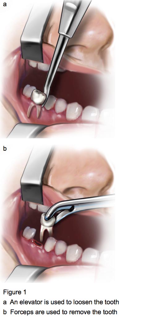Figure 1 - Tooth removal