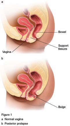 Figure 1 posterior prolapse