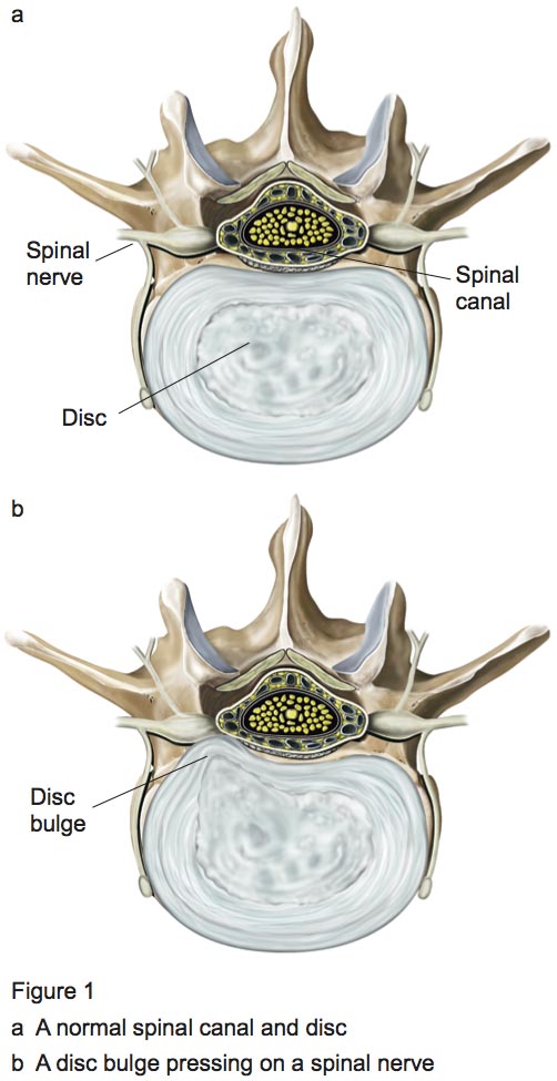 Figure 1 - Lumbar dissectomy