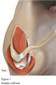 Rotator cuff repair figure 1