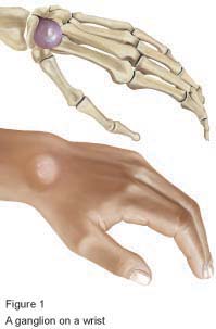Figure 1 - Wrist ganglion