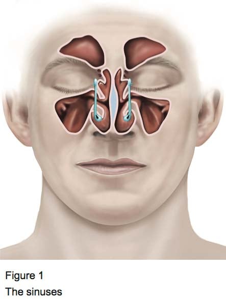 Sinus surgery