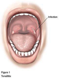 Tonsillectomy