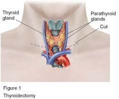 Total Thyroidectomy