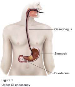 Figure 1 - Upper GI Endoscopy