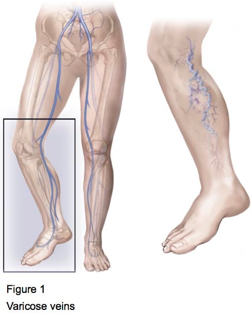 Figure 1 - Varicose veins