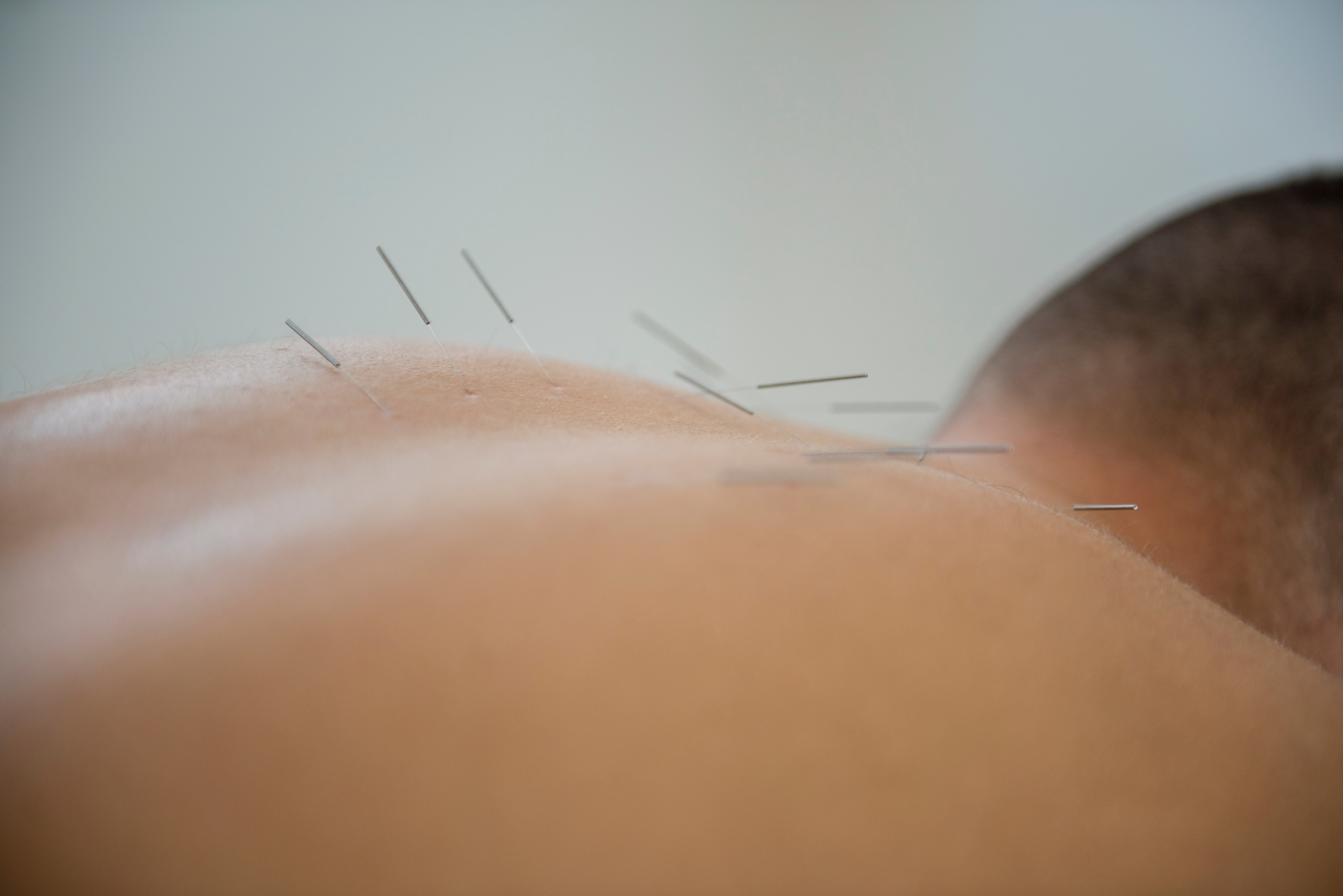 Needles in a man's back 