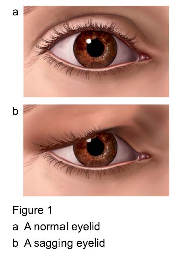 Figure 1 - Blepharoplasty