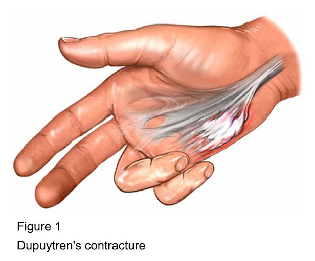 Figure 1 - Dupuytren's Contracture