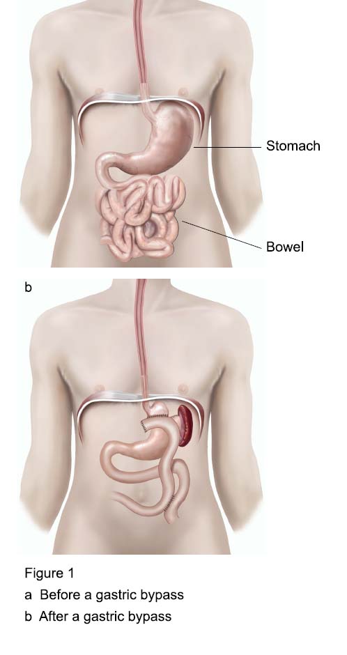 Gastric bypass